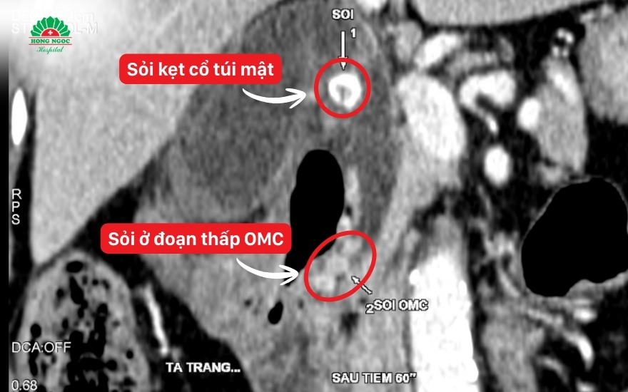 phau-thuat-noi-soi-cat-tui-mat