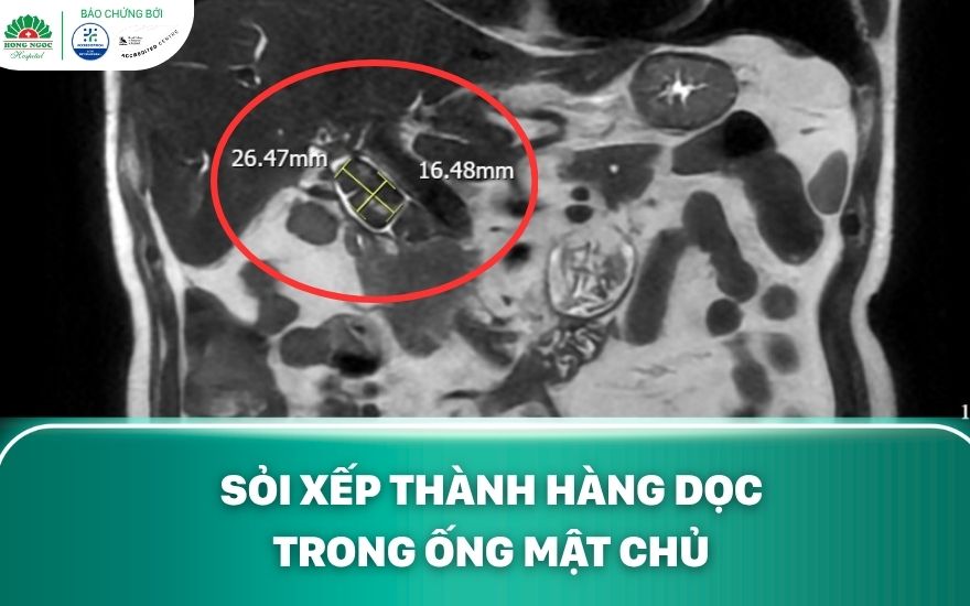 phau-thuat-mo-duong-mat-lay-soi