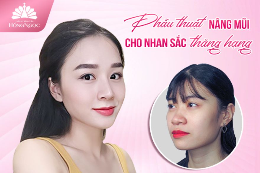 phẫu thuật nâng mũi
