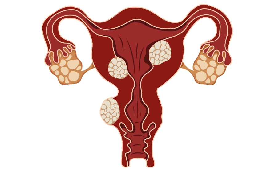 Quá sản nội mạc tử cung