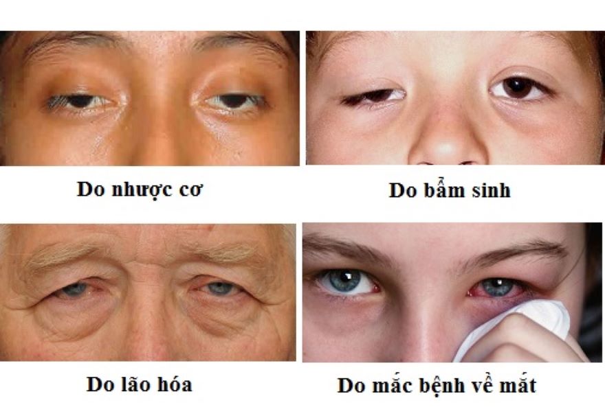 các nguyên nhân gây sụp mí mắt