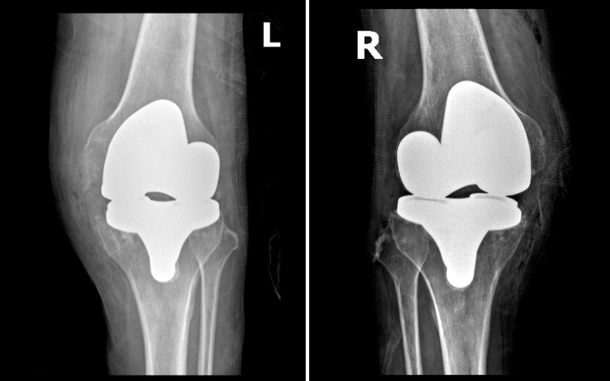 Thay Khop Goi Bn Giang