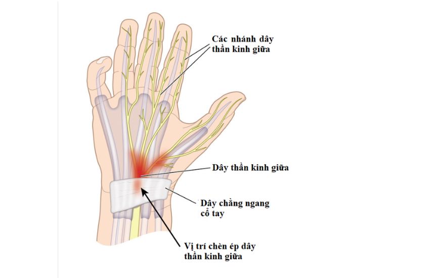 Tổn thương thần kinh giữa