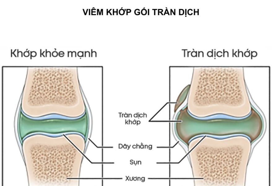 tràn dịch khớp gối