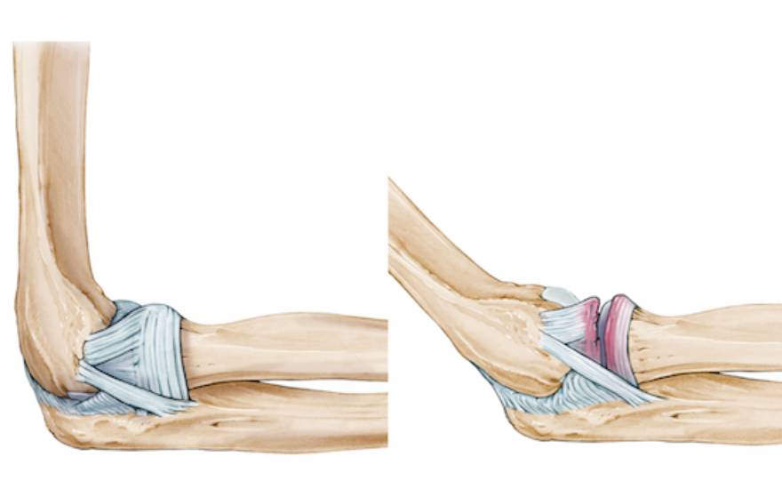 trật khớp khuỷu