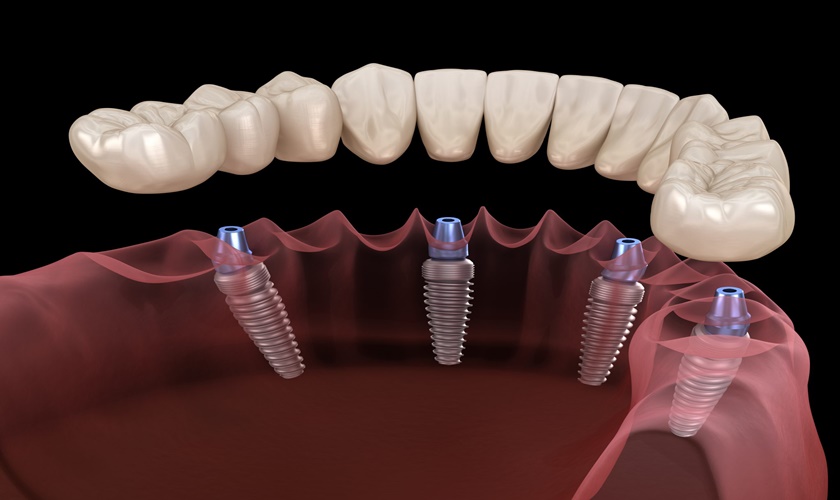 implant phục hình toàn hàm All on 4
