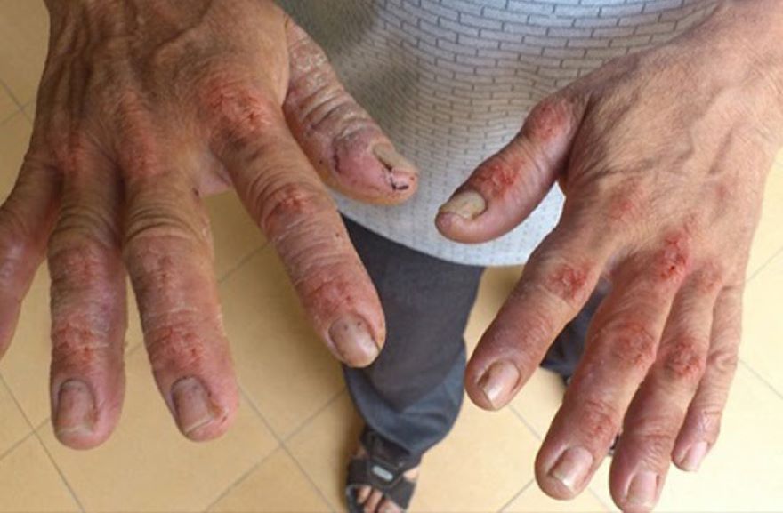 viêm da tiếp xúc kích ứng