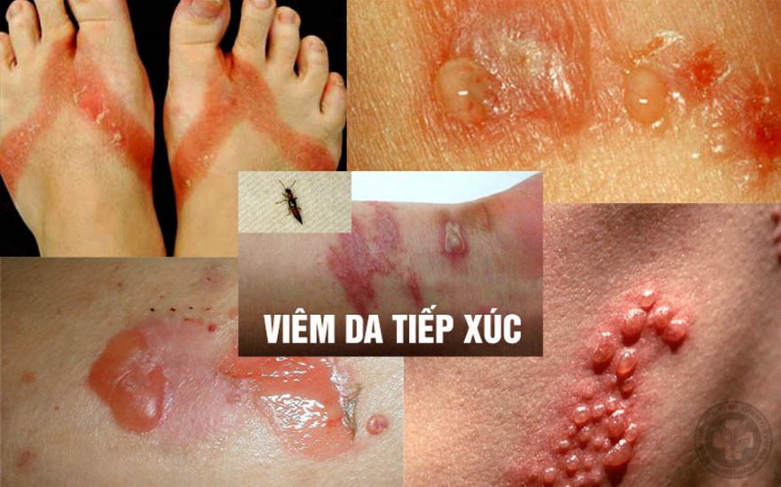 viêm da tiếp xúc do kiến ba khoang đốt