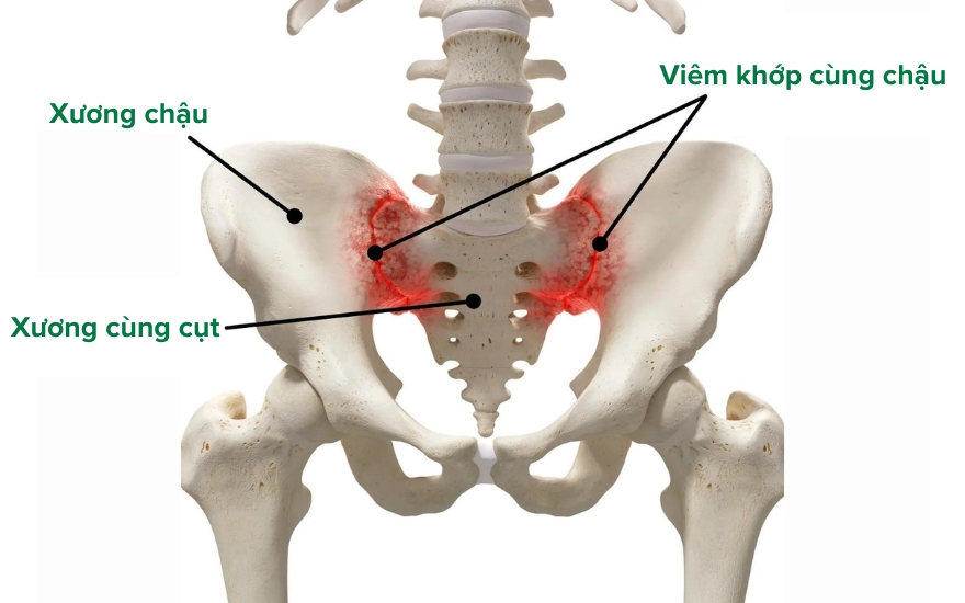 viêm khớp cùng chậu