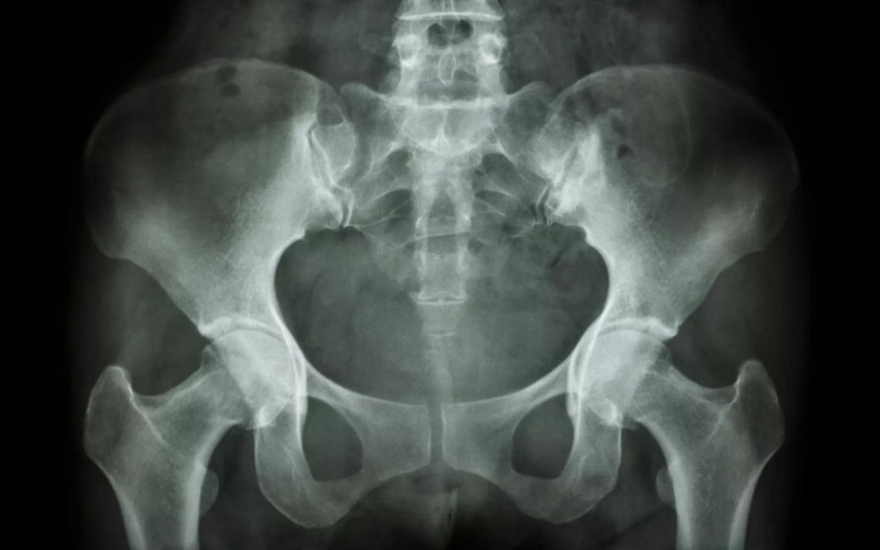 viêm khớp cùng chậu