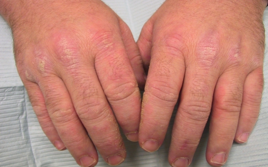 viêm khớp phản ứng