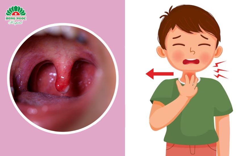 viêm mũi họng ở trẻ