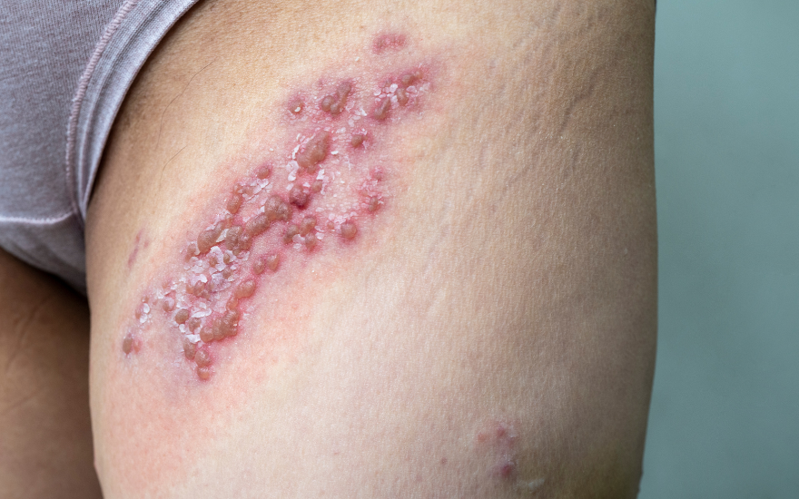 mọc mụn ở vùng kín