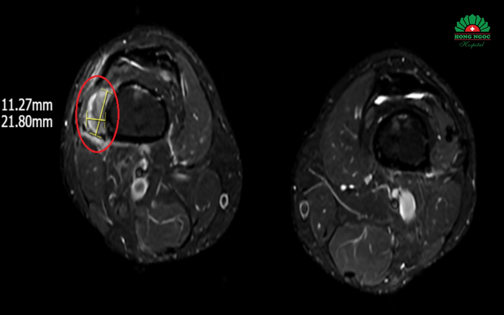Hình ảnh khối u vùng vị trí phần mềm dưới đùi phải trên phim MRI
