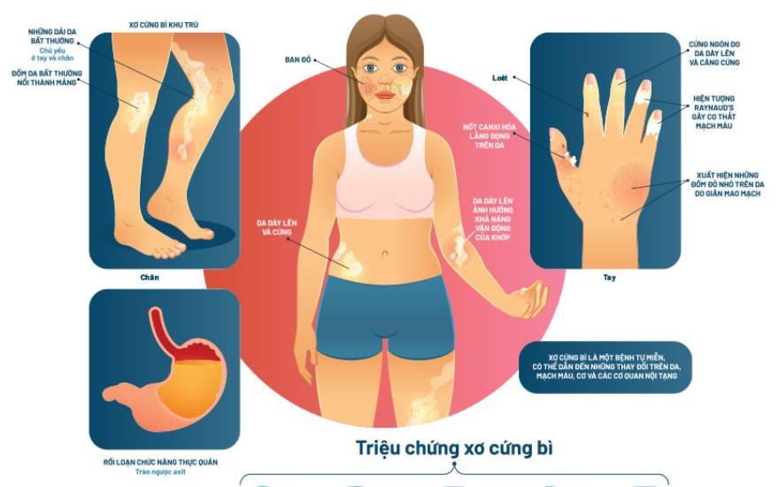 xơ cứng bì toàn thể