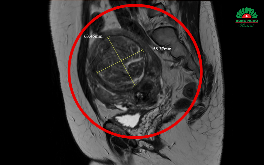 Nút Mạch U Xơ Tử Cung 1