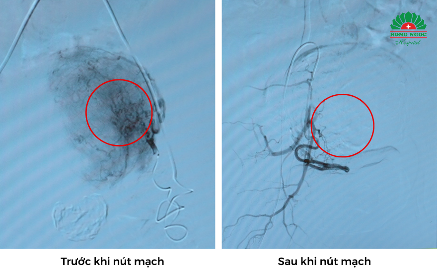 Nút Mạch U Xơ Tử Cung 2