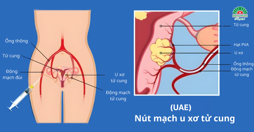 Phương Pháp Nút Mạch Uxtc