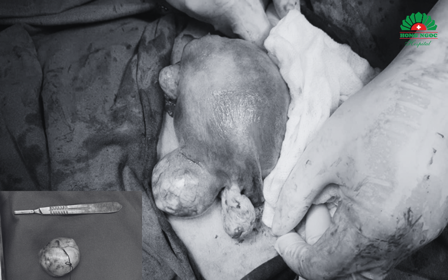 Mổ đẻ Bóc U Xơ 1