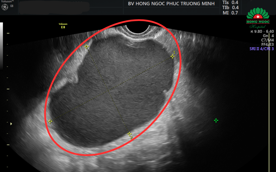 Phau Thuat U Nang Socola 2