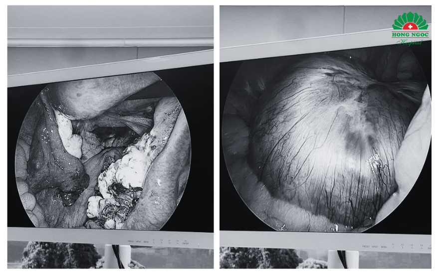 Phau Thuat U Nang Socola 3