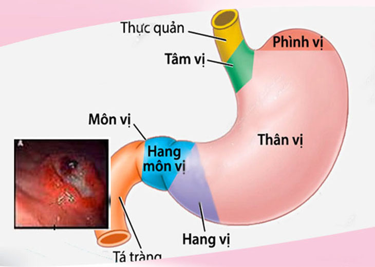 Phù Nề Hang Vị Dạ Dày: Nguyên Nhân, Triệu Chứng Và Cách Điều Trị Hiệu Quả