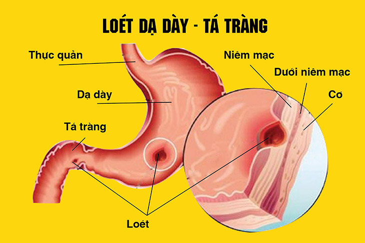 Đau Dạ Dày Tá Tràng: Nguyên Nhân, Triệu Chứng và Phương Pháp Điều Trị Hiệu Quả