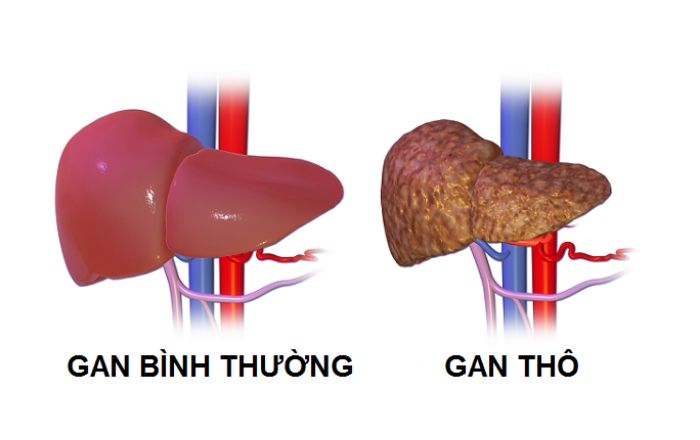 Gan Phản Âm Thô Là Gì? Nguyên Nhân, Triệu Chứng Và Cách Điều Trị