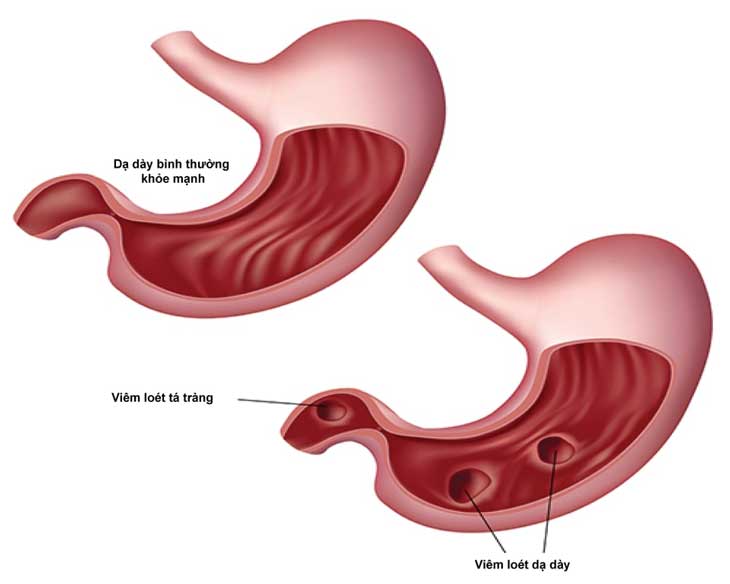 4. Phương pháp điều trị xuất huyết dạ dày