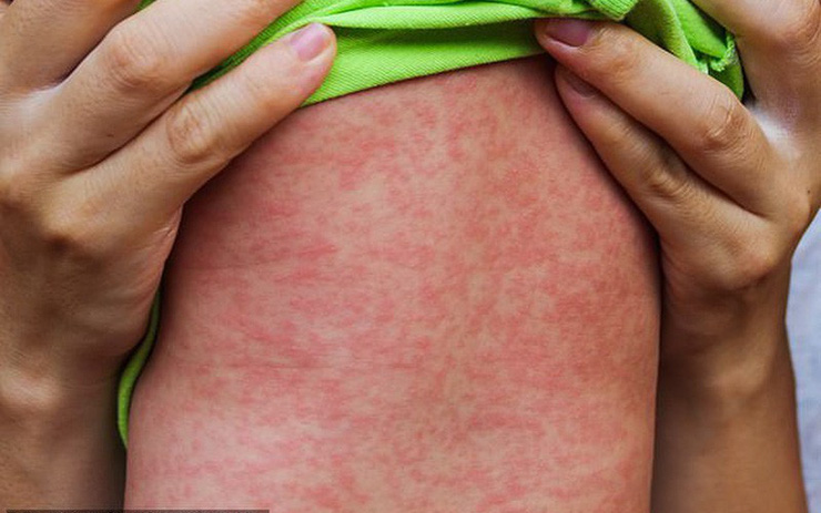 Virus Gây Bệnh Sởi: Nguyên Nhân, Triệu Chứng và Cách Phòng Ngừa Hiệu Quả