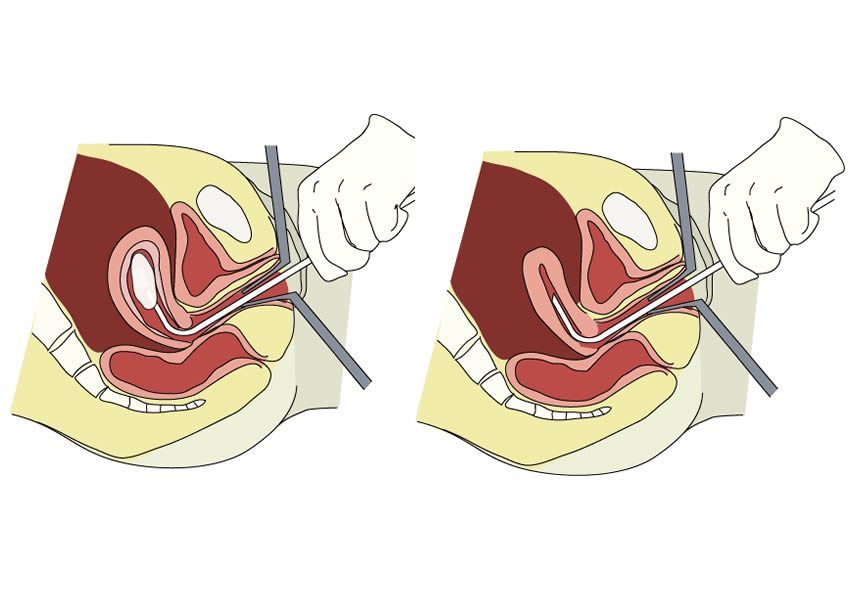 Thời điểm hút thai an toàn
