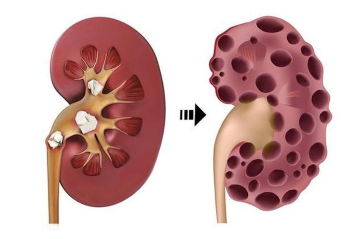 Nguyên Nhân Gây Ra Bệnh Sỏi Thận Sinh 8: Hiểu Rõ Để Phòng Tránh Hiệu Quả