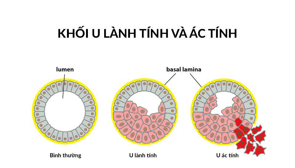 1. Tổng quan về ung thư lành tính