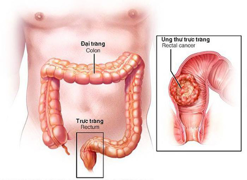 4. Điều Trị Polyp Trực Tràng