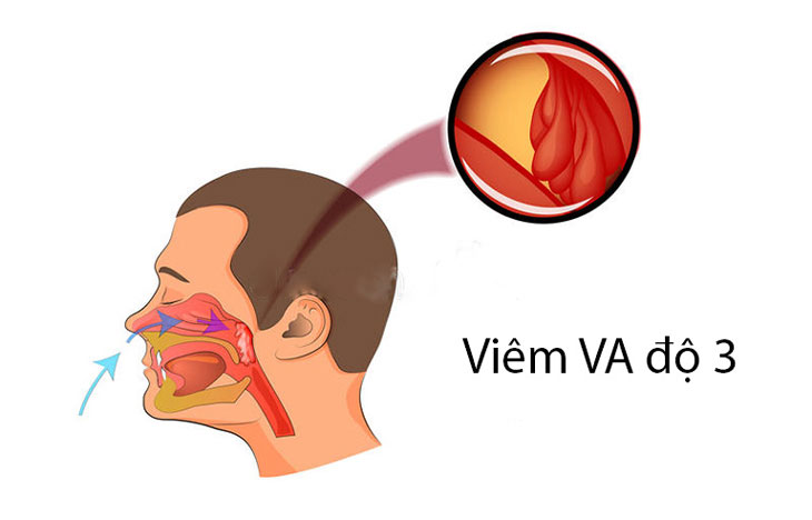 Viêm VA độ 3: Triệu chứng, Biến chứng và Phương pháp điều trị hiệu quả