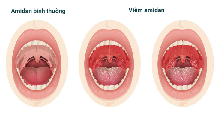 Viêm Amidan Giả Mạc: Dấu Hiệu và Cách Điều Trị Hiệu Quả