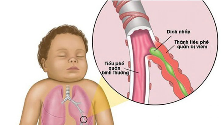 Viêm tiểu phế quản cấp ở trẻ sơ sinh: Nguyên nhân, triệu chứng và cách điều trị hiệu quả