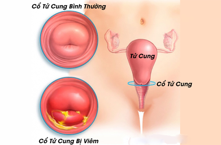 Cách phòng ngừa vô sinh nguyên phát