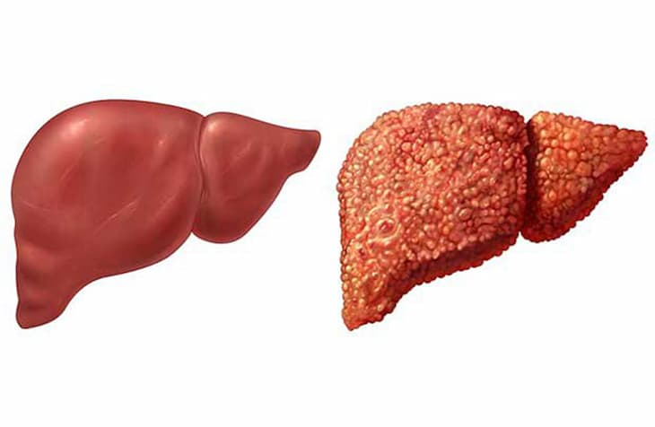 5. Lối Sống Và Chế Độ Chăm Sóc Dành Cho Bệnh Nhân Xơ Gan