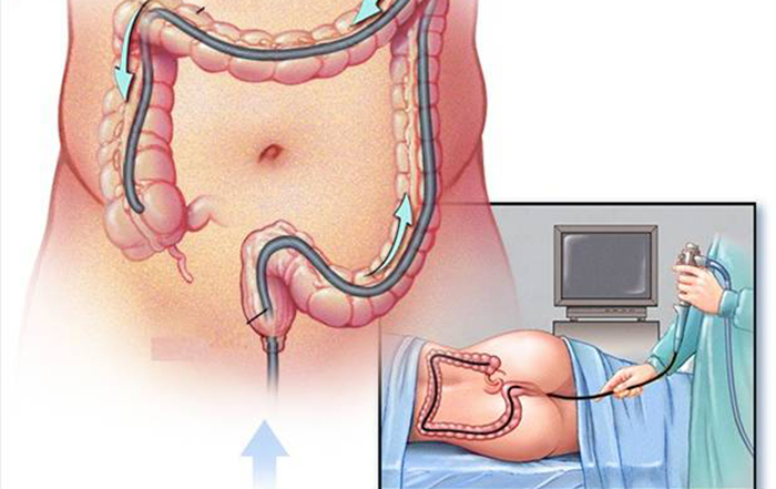 Nội Soi Đại Tràng Gây Tê: Quy Trình, Lợi Ích Và Những Điều Cần Biết