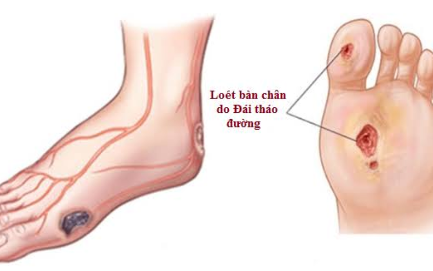 Biến chứng của đái tháo đường type 2