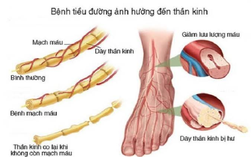 Các biến chứng tiền tiểu đường