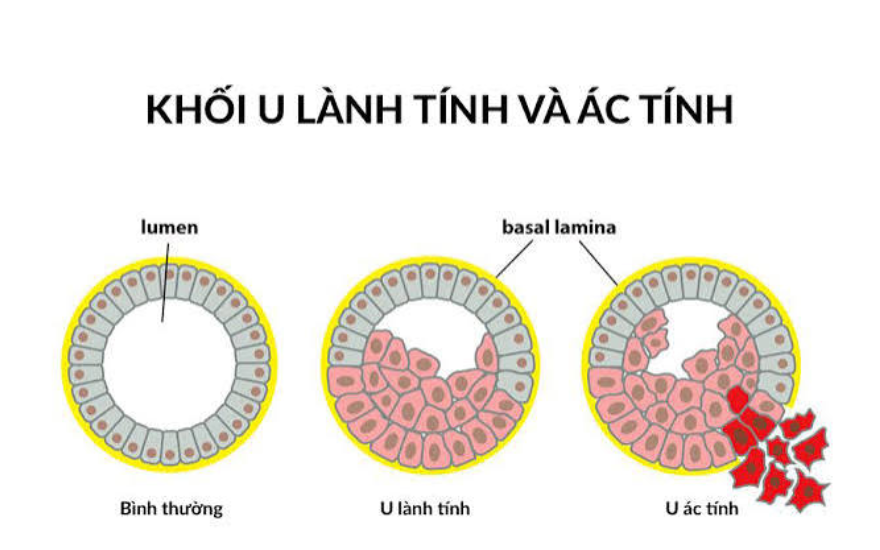 Cách phân biệt u mỡ lành tính với u ác tính