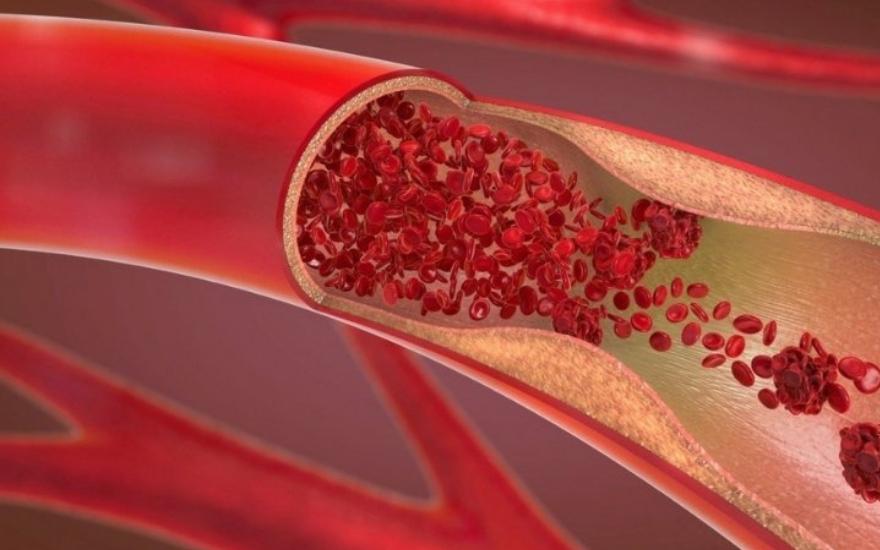 Cholesterol cao là tình trạng nồng độ cholesterol trong máu tăng lên vượt mức bình thường