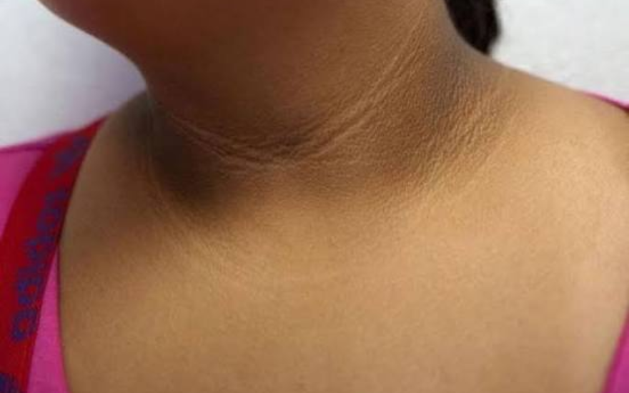 Dấu hiệu đái tháo đường type 2