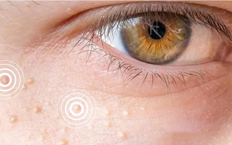 Khi xuất hiện các nốt vàng dưới da ở vùng quanh mí mắt là dấu hiệu cảnh báo mỡ máu cao