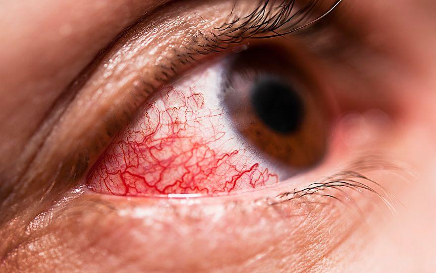 Virus gây bệnh đau mắt đỏ dễ dàng lây lan từ người sang người thông qua việc tiếp xúc trực tiếp với dịch tiết.