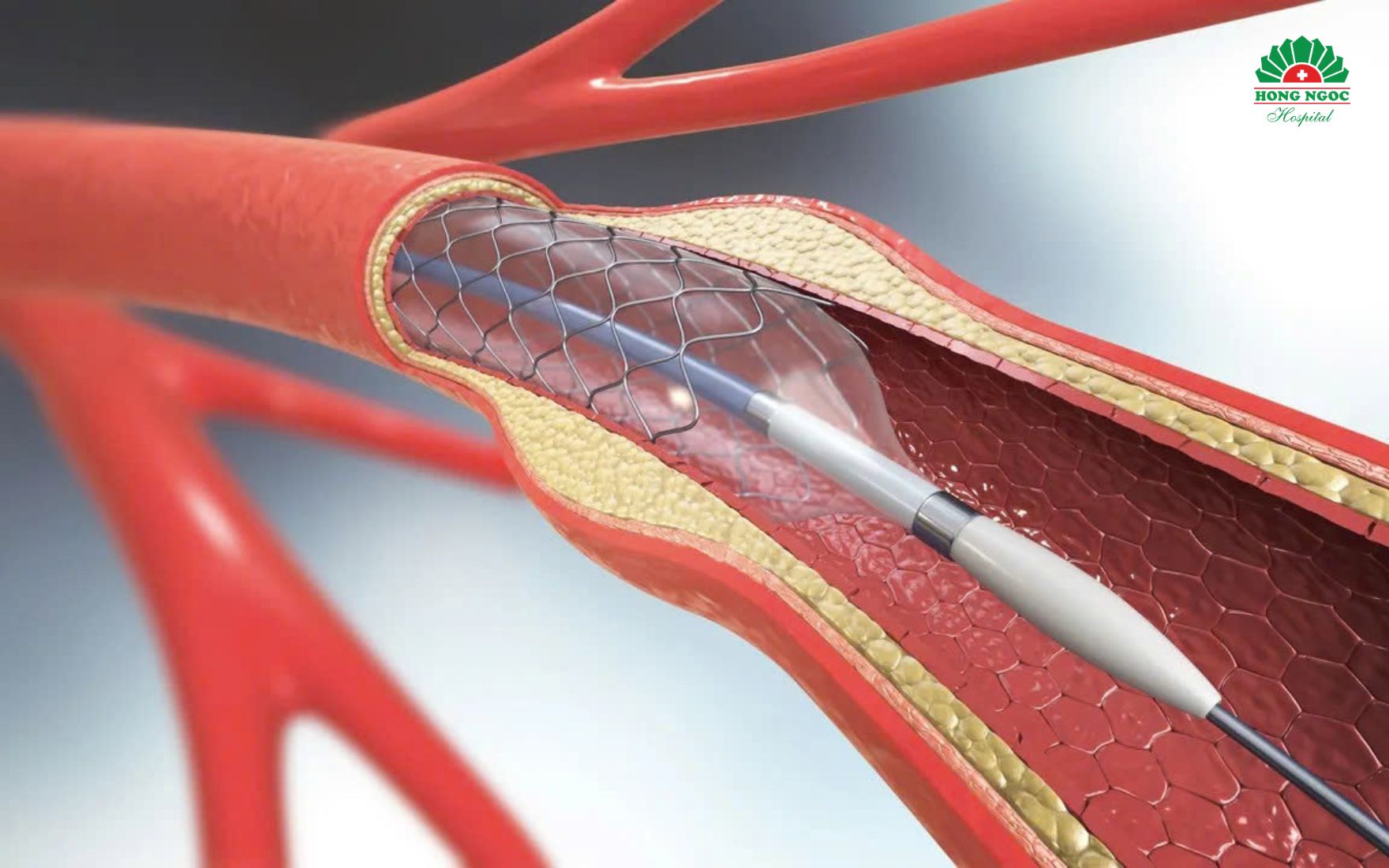 dat-stent-dong-mach-ngoai-bien.jpg