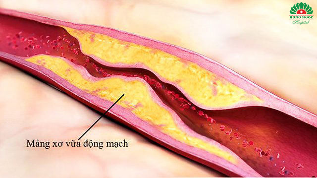 hinh-anh-xo-vua-dong-mach.jpg