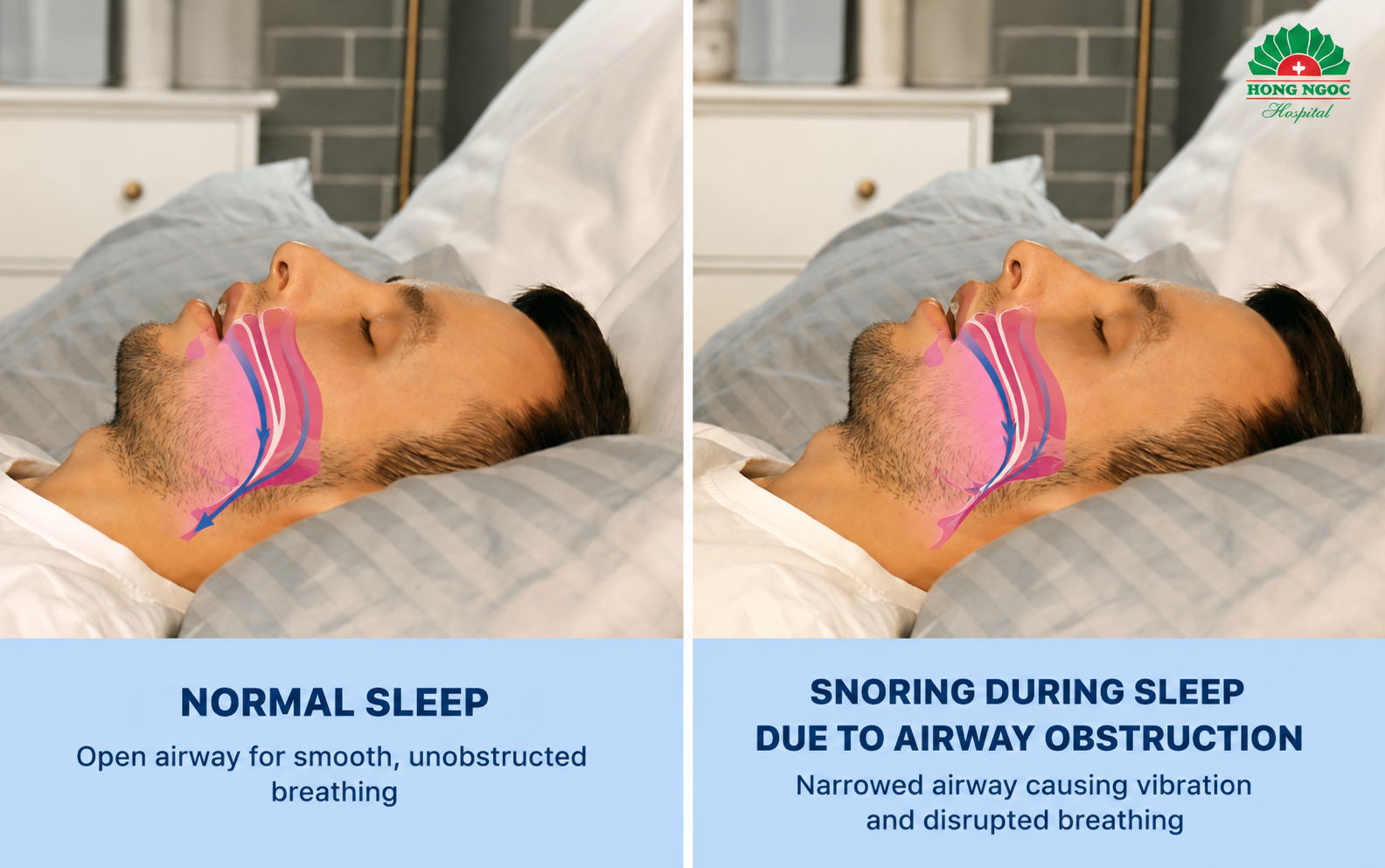 People with overweight or obesity have a higher risk of obstructive sleep apnea.